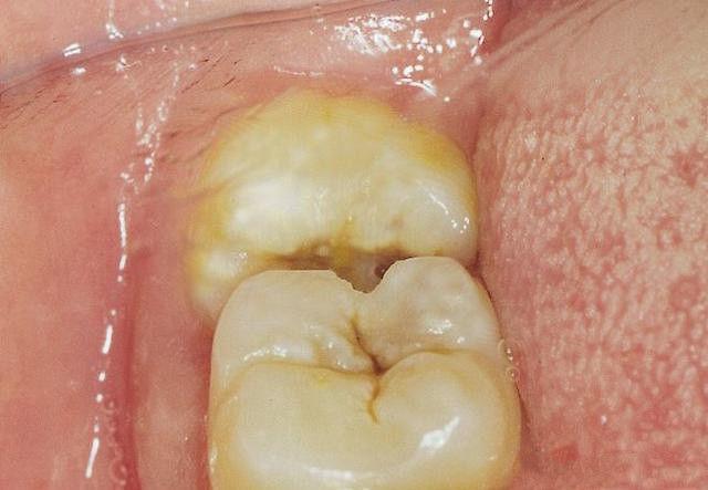 拔智齿后遗症太多了（智齿拔了以后有影响吗）(图3)