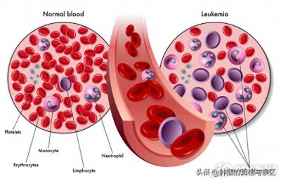 ​白血病早期的8个征兆(持续有这4个表现，不用怀疑，是白血病征兆)
