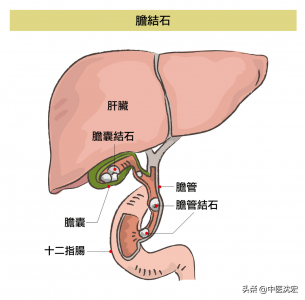 ​胆结石比较严重是摘除胆囊好还是取石头好 胆结石用切胆囊吗