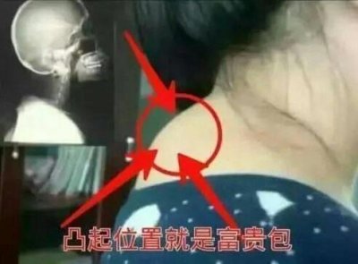 ​脖子后面的“富贵包”很多人都有，实则是个“夺命包”不得不重视